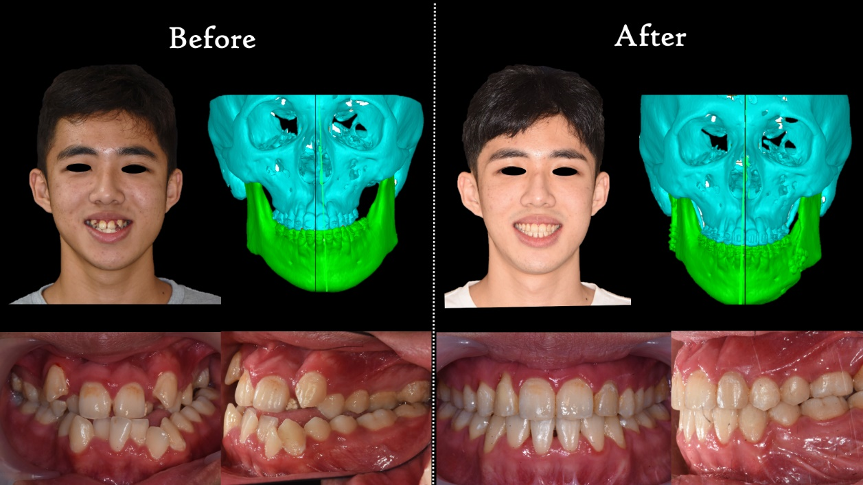圖三 嚴重咬合不正與顏面歪斜男性，經矯正與正顎手術改善功能與美觀